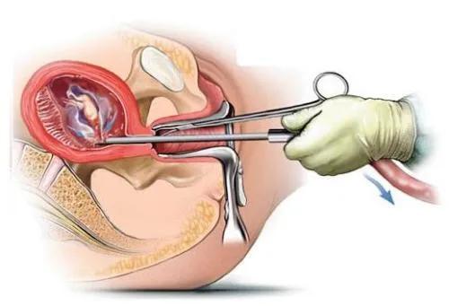早孕人工流产和中孕引产的操作过程及风险
