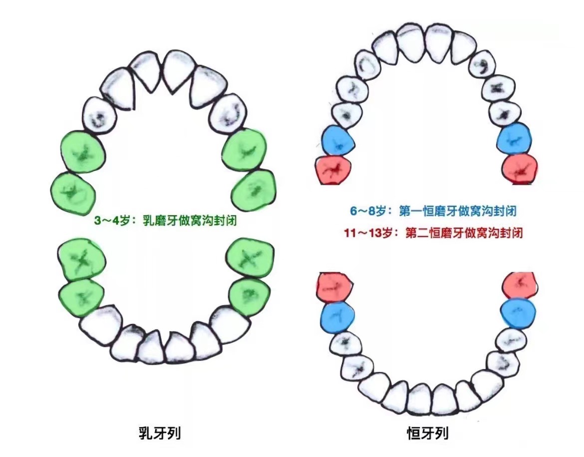 两种公认最有效的儿童防龋方法——涂氟和窝沟封闭，家长建议收藏