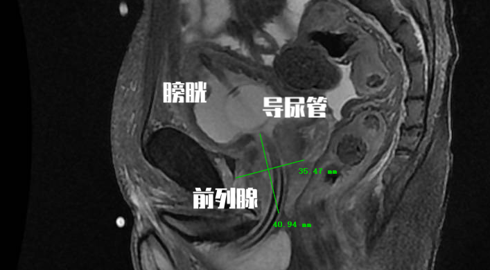 前列腺增生不能根治，那这个手术做了有什么用？为啥还要做手术？