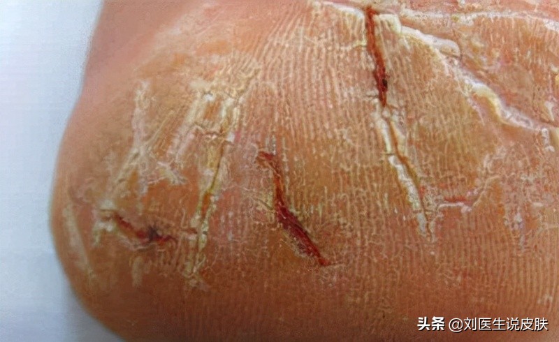 手脚皲裂有救了！教你「白+黑」护理方法，重现柔嫩肌肤