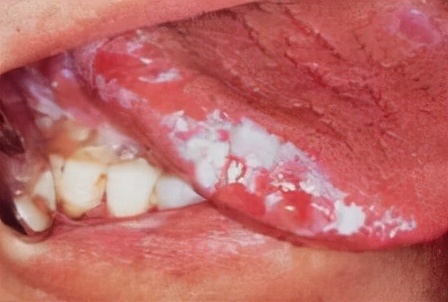 舌炎的症状图片(再次提醒) - 赤虎壹号