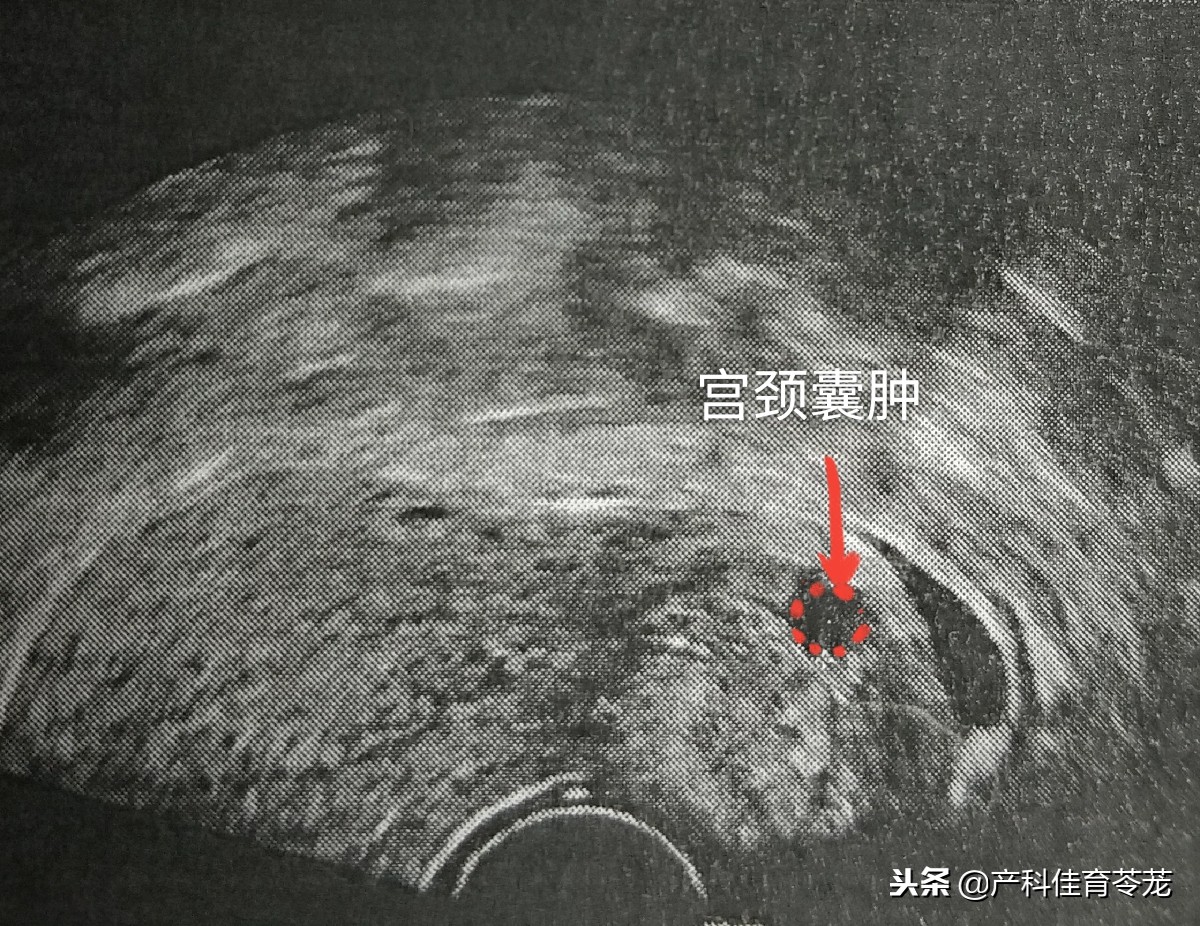 宫颈上的囊肿,多数不需治疗