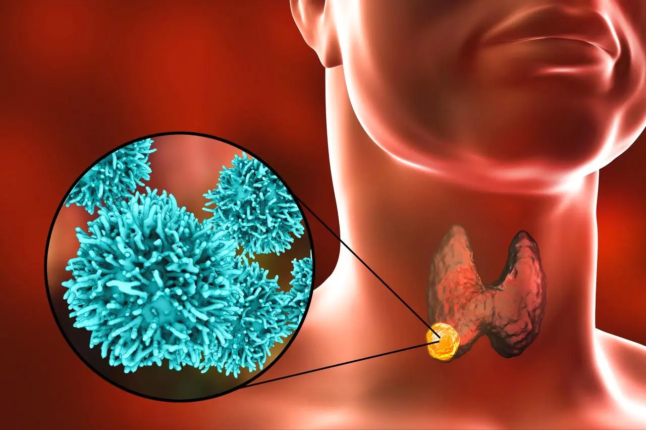 甲状腺癌手术后能活几年（要注意什么）