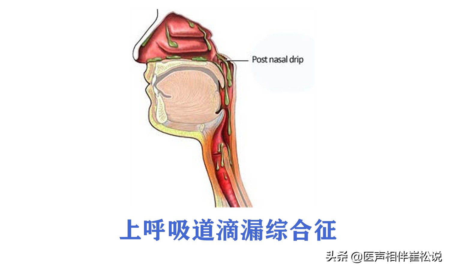 咳嗽其实不是坏事！是保护性反射！长期咳嗽别忘了这5种原因