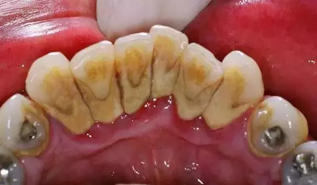 花100多块钱洗一次牙,到底值不值?