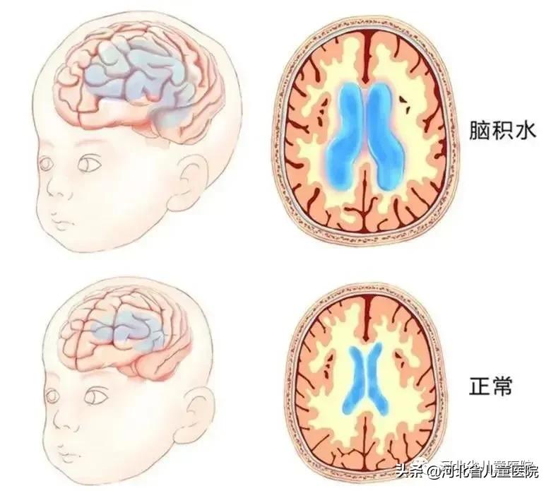 大头宝宝的症状和图片图片