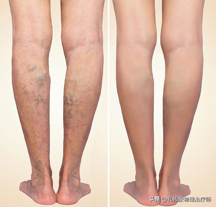 腿上盘踞的血管像"小蚯蚓"一样,是啥病?本文告知您治疗及预防
