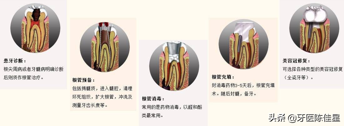 任何根管治疗都是没必要的？真实案例分析！缺乏医学知识