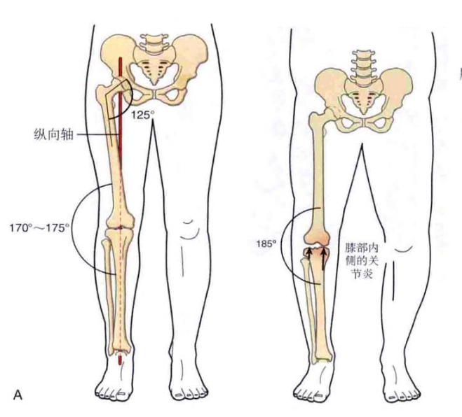 为什么nba球星膝盖不疼(詹姆斯也是O型腿，为什么他膝关节不疼，而我打篮球就腿痛呢？)