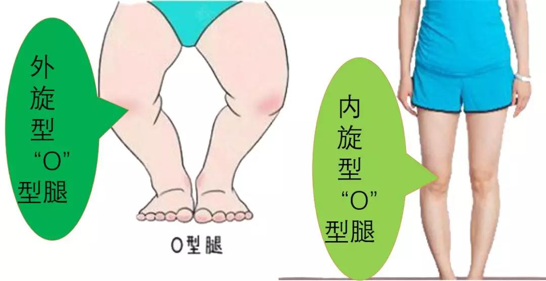 孩子O型腿，需要治疗吗？