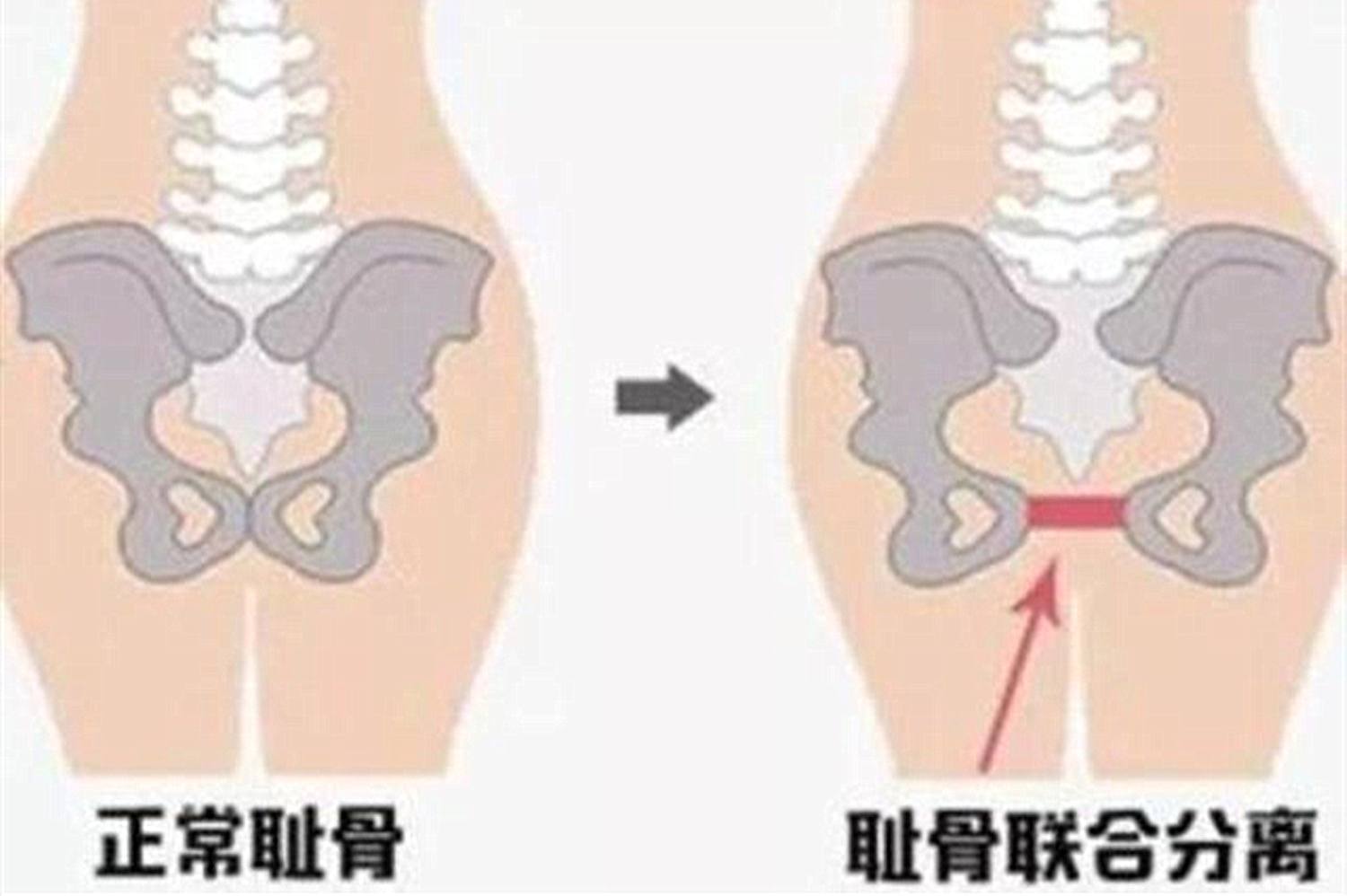 有种疼痛叫“耻骨痛”，这5种孕妇还会“疼痛加倍”，孕妈要注意