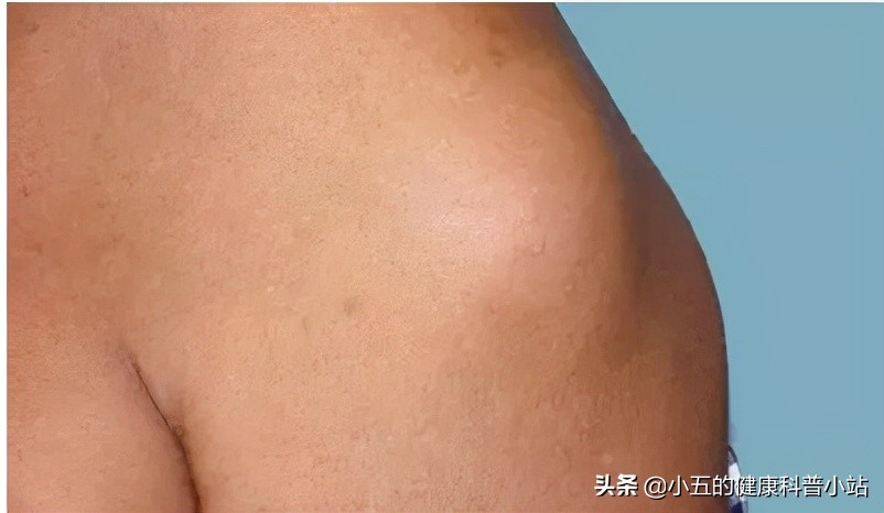 什么是脂肪瘤,它会癌变吗,我们应该怎么正确治疗脂肪瘤