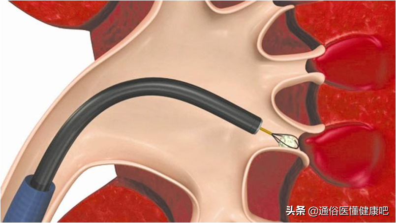 体外冲击波“碎石”和输尿管软镜“取石”，谁更“胜”一筹？