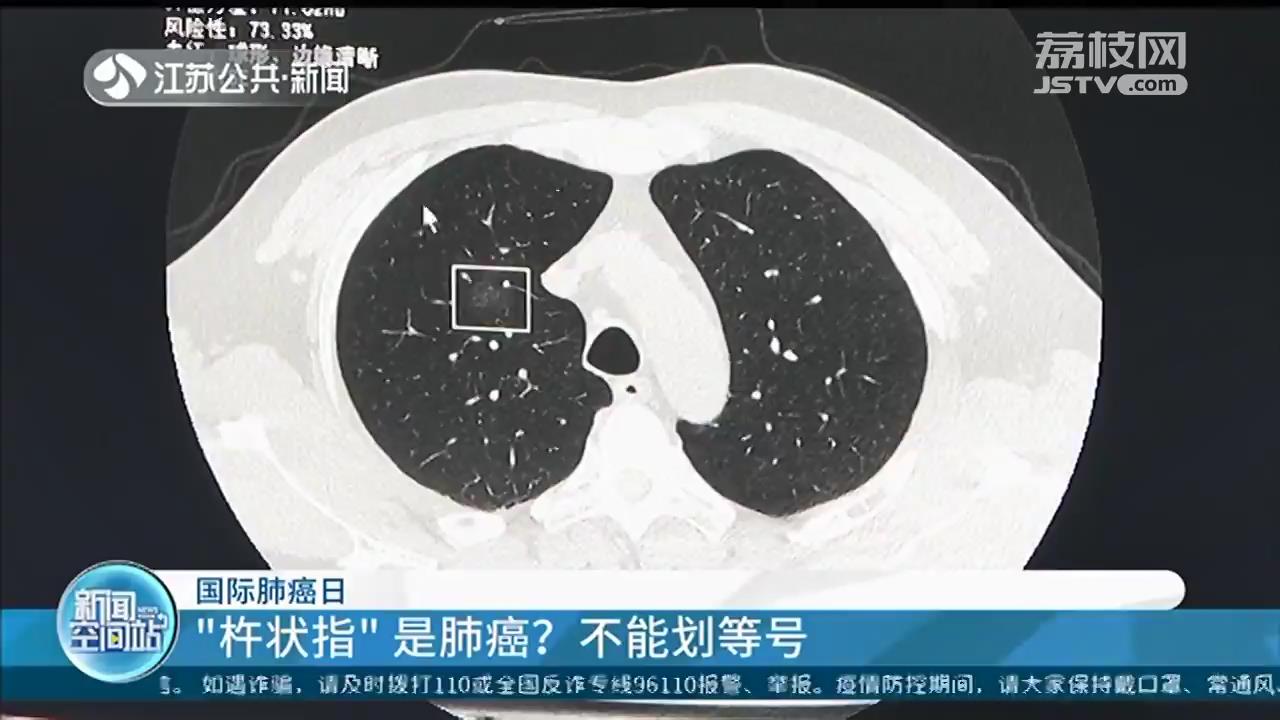 「国际肺癌日」“杵状指”是肺癌？不能划等号