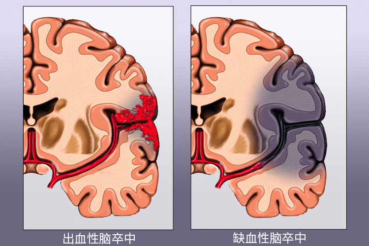 世界卒中日｜警惕卒中症状，尽早发现救治