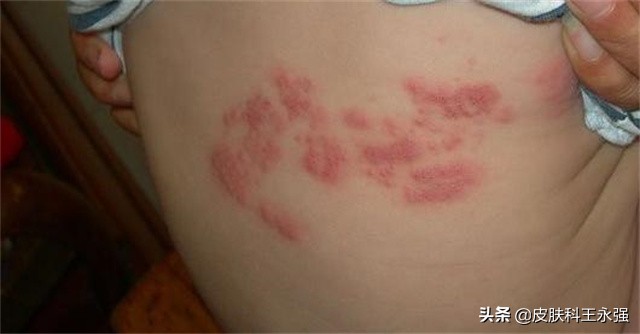 湿疹、带状疱疹，擦什么好得快？