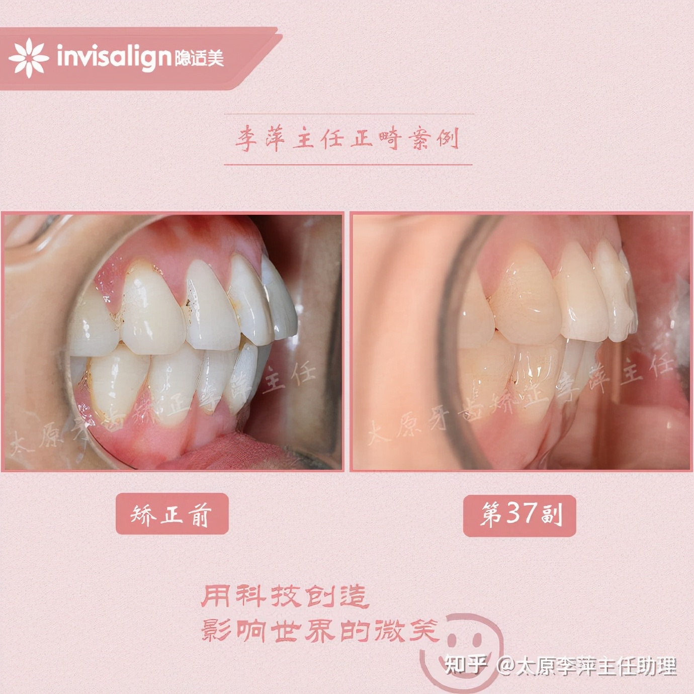 太原牙齿矫正：隐形牙套效果好不好？看这些病例你就知道了