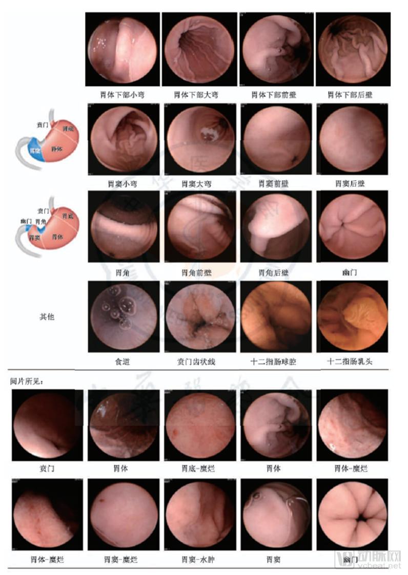 10万胶囊胃镜数据透视中国消化道健康状况，探讨器械智能化价值