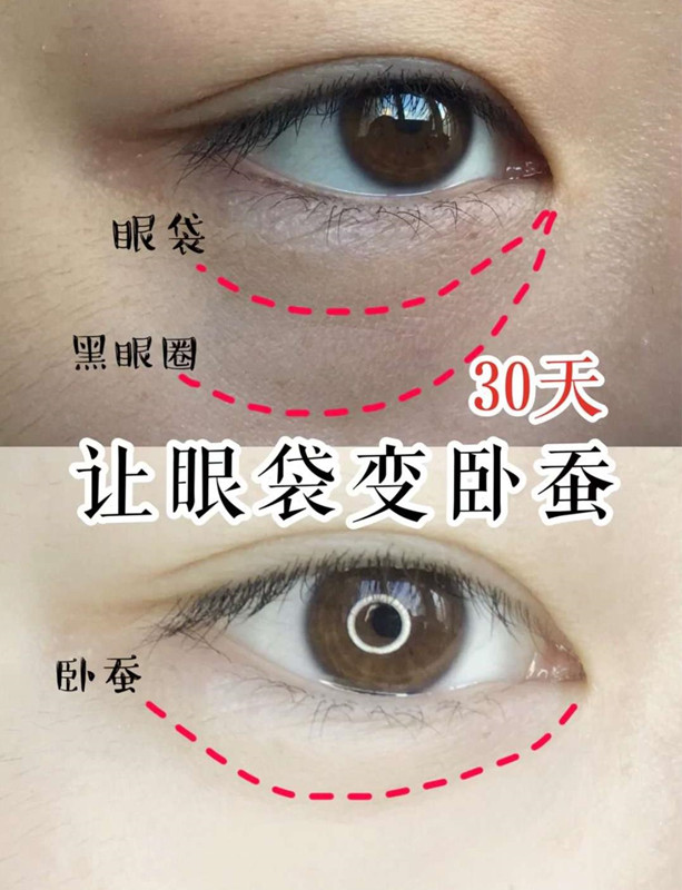 要不要手术“祛眼袋”?医生讲解手术后遗症,网友:不敢去了