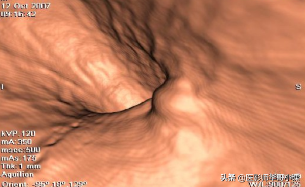 胃，3D立体重建技术，还您一个实实在在的胃。网友：价格多少呢