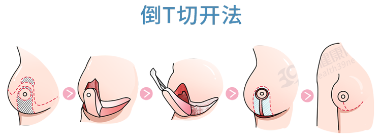 乳房巨大(被“巨乳症”折磨的女生，有苦说不出：就像胸前挂着11瓶矿泉水)