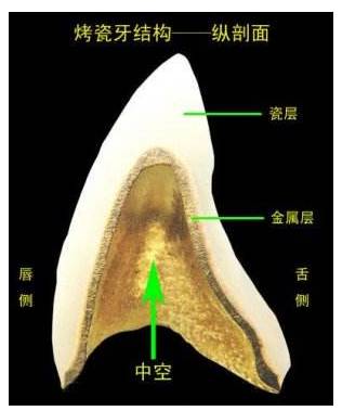 全瓷牙比烤瓷牙到底差在哪？价格为什么悬殊这么大？听听牙医解释