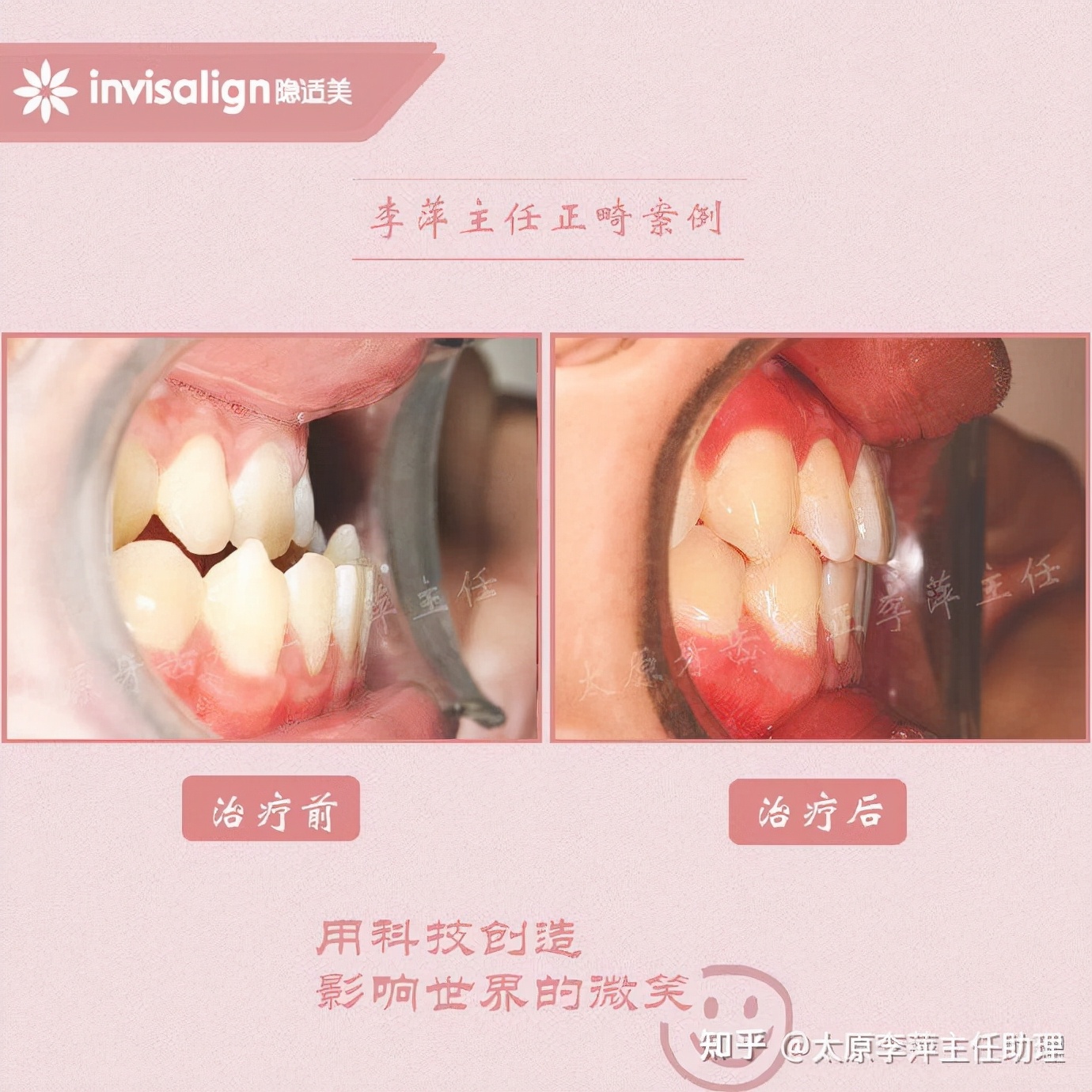 太原牙齿矫正：隐形牙套效果好不好？看这些病例你就知道了