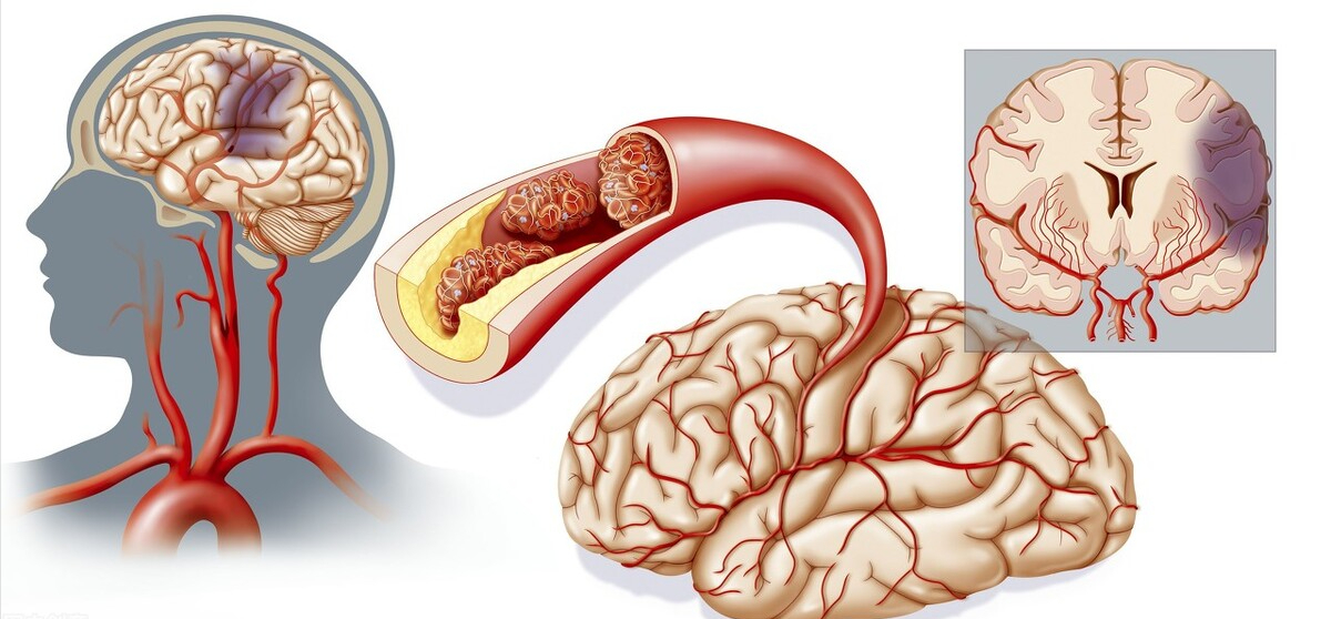 神经元受损怎么治(3类药物)