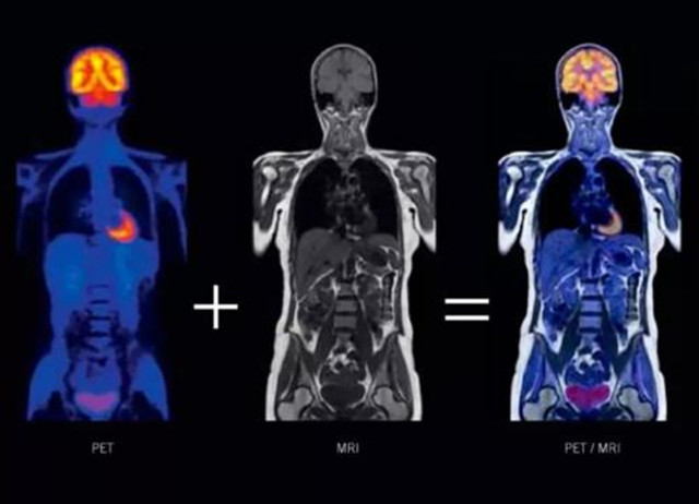 最贵的查癌神器：PET-CT，一次能查全身肿瘤，为何不建议正常人做