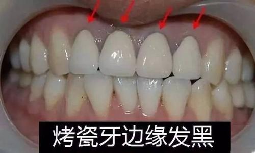 烤瓷牙装久了出现黑边，连带牙龈发炎变色？牙科医生告诉你为什么