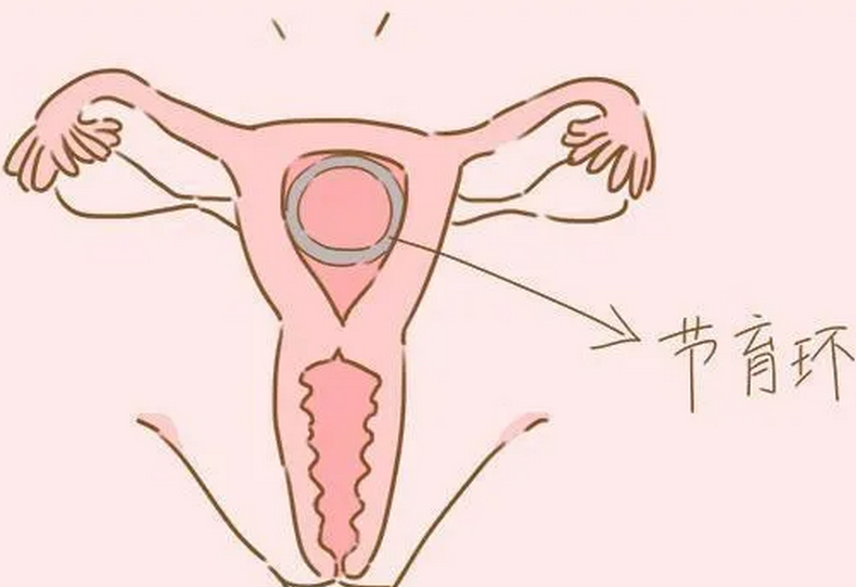宫内节育器,又称节育环(iud),是放置在子宫腔中用于避孕的