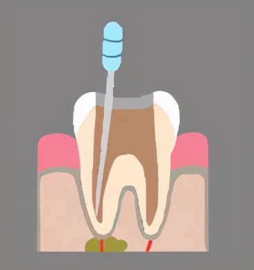 根管治疗是不是就是“杀神经”？