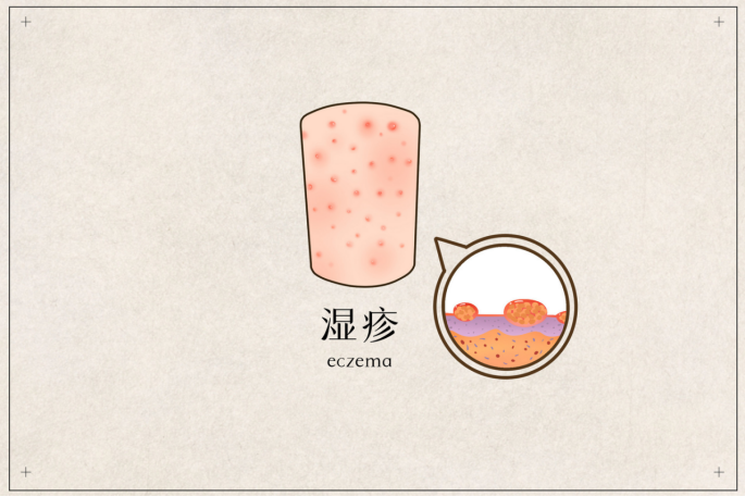 宝宝湿疹反复发作？十大湿疹药膏品牌推荐助你告别烦恼