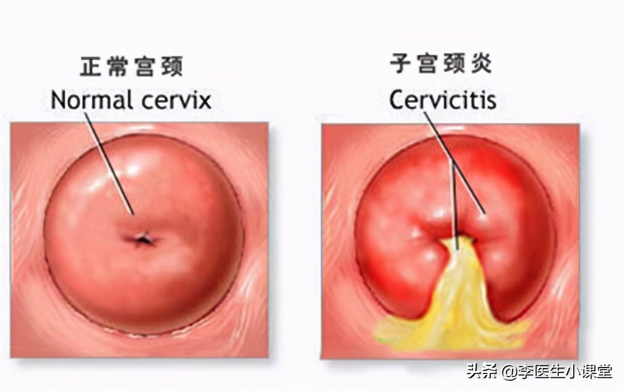 “淋病”是什么？如何治疗和预防？
