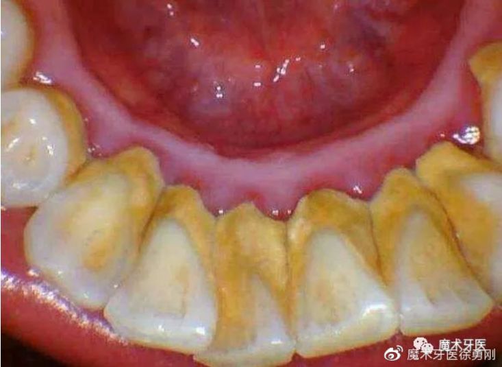 牙周炎，中国人后半生无法摆脱的痛