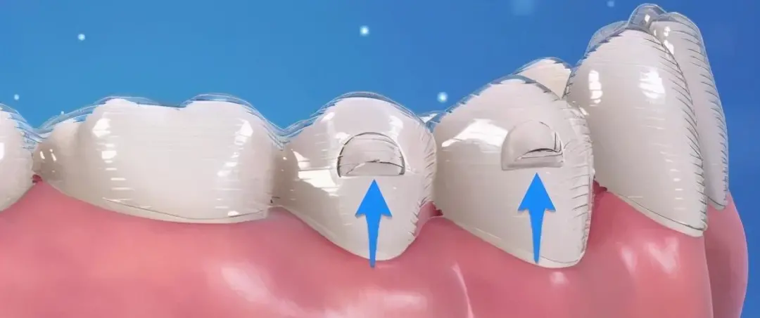 隐形牙套和透明保持器，它们到底有啥区别？
