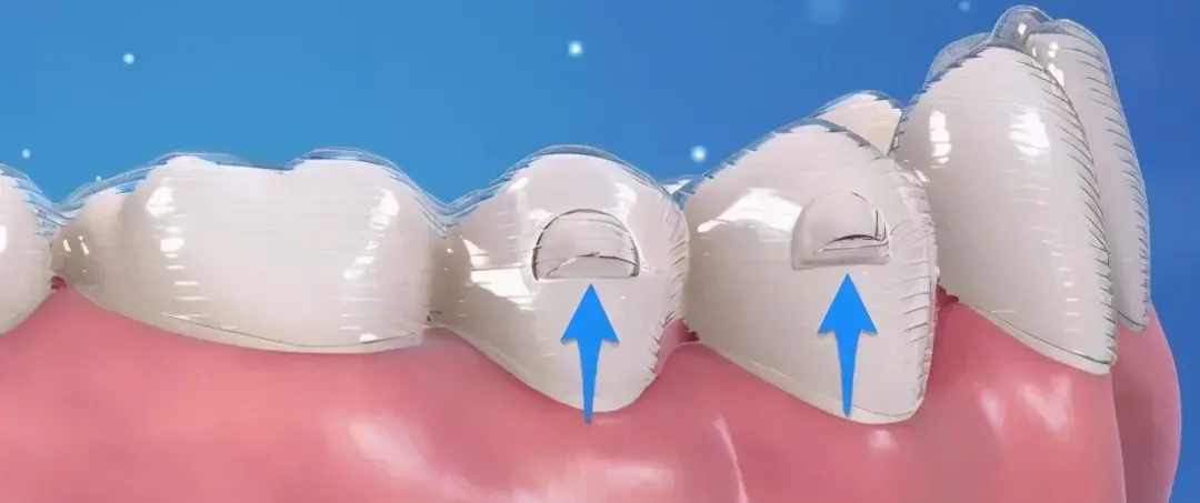 隐形牙套和透明保持器,它们到底有啥区别?