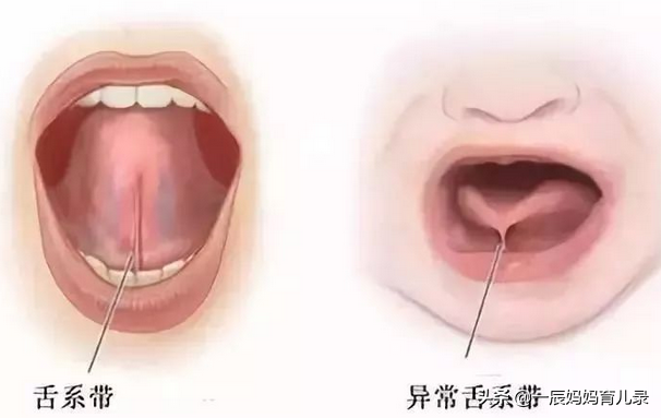 宝宝发音不准、吐字不清，舌系带短？该剪不该剪？别错过最佳时期