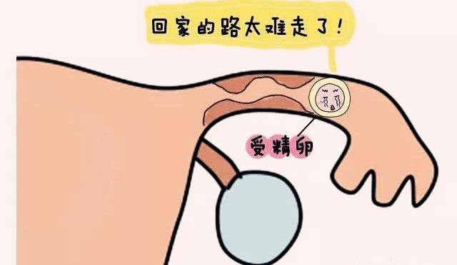 现在这么多宫外孕，什么原因？