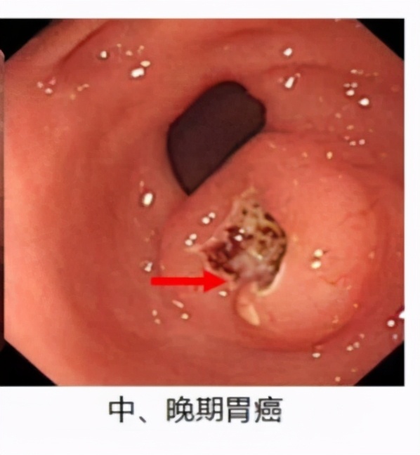 95%的体检都查不出癌症：癌症早筛是真有用，还是智商税？