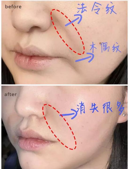 让日本女人夜夜疯狂的神器，法令纹、眉间纹克星！一贴＝10次除皱