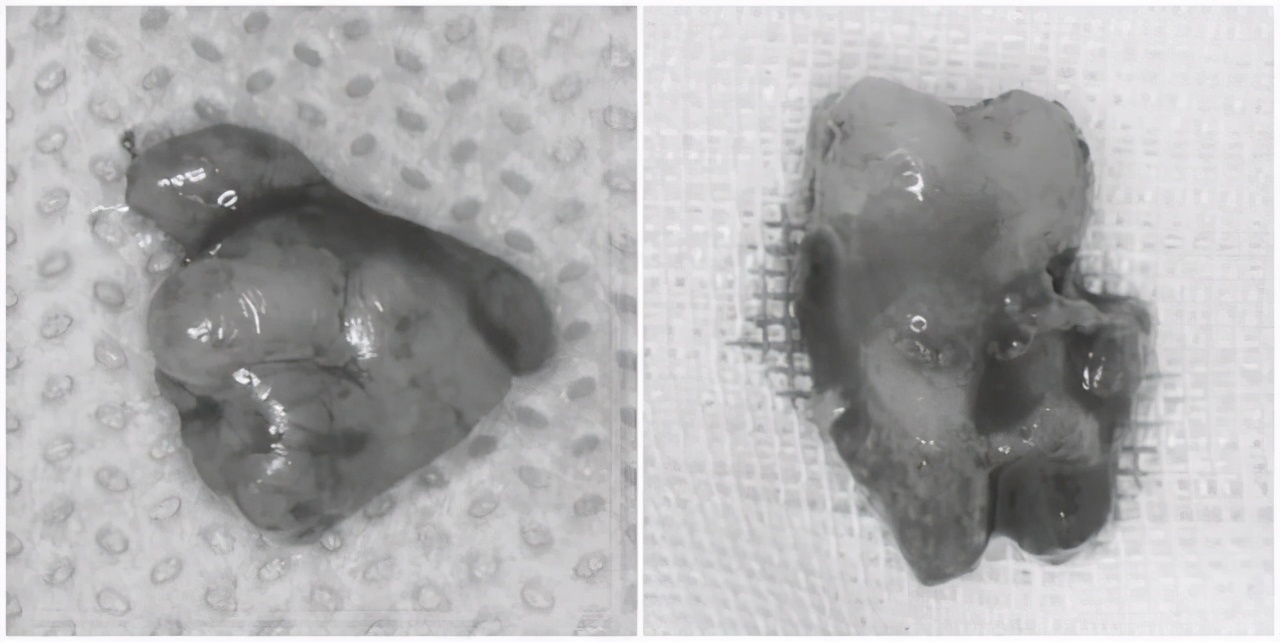牙龈长了一个小疙瘩,不痛不痒,医生却说这是一个肿瘤?