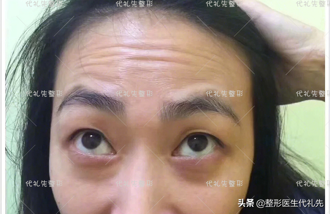 有了抬头纹要怎么办？会让人显老显衰压眼睛，有抬头纹的来看看