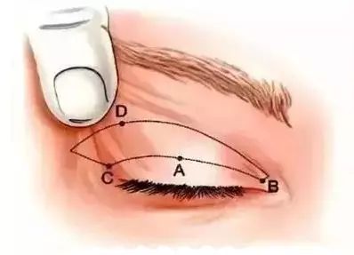 上眼皮肤松弛厉害，做提眉好还是双眼皮好？