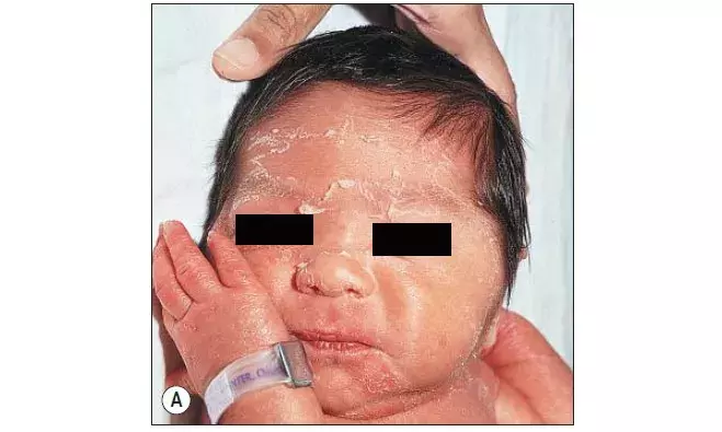 婴儿的马牙什么时候消(12种新生儿皮肤问题大集合) 