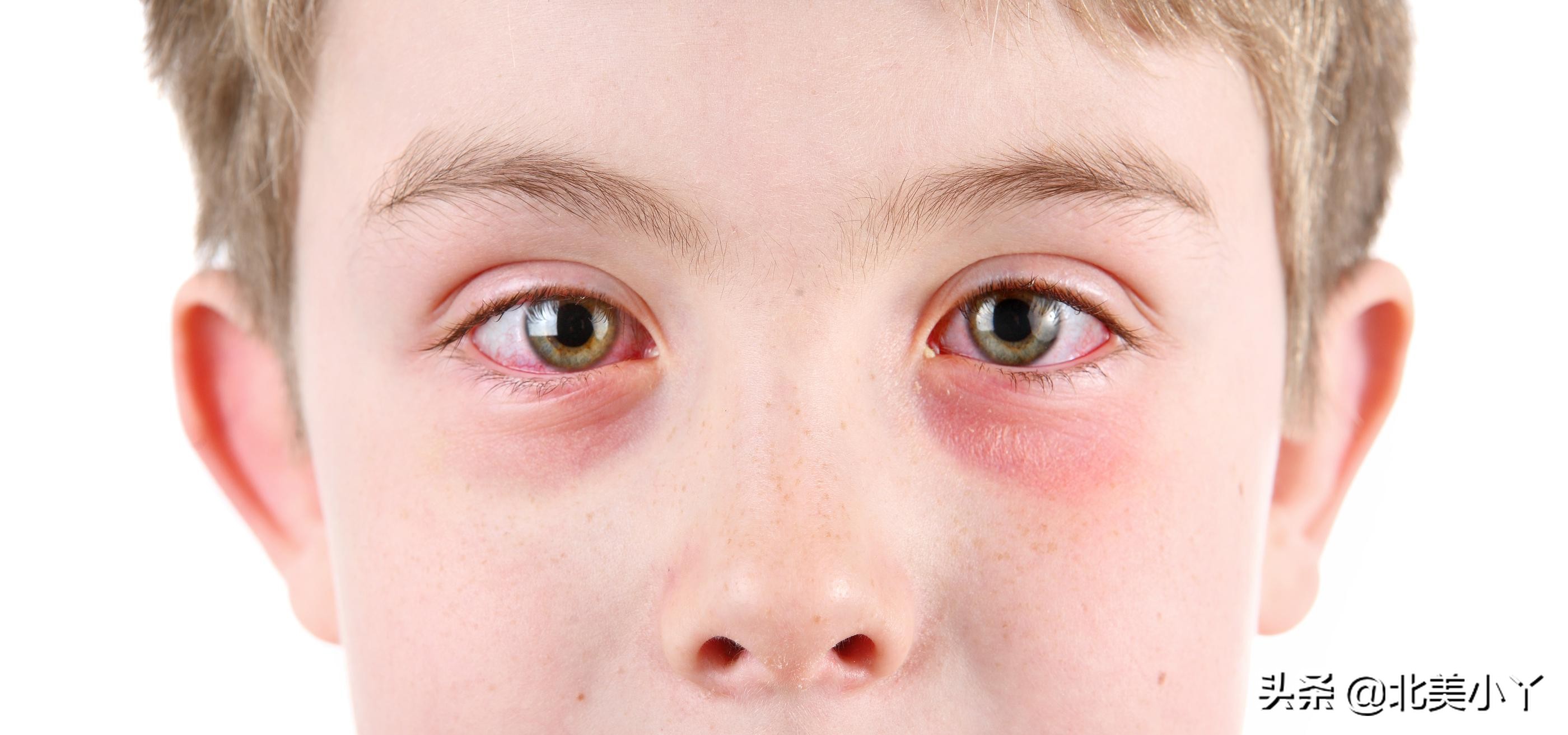 小丫说医 | 出现眼睛红肿,有眼屎未必是上火了,要警惕3种结膜炎