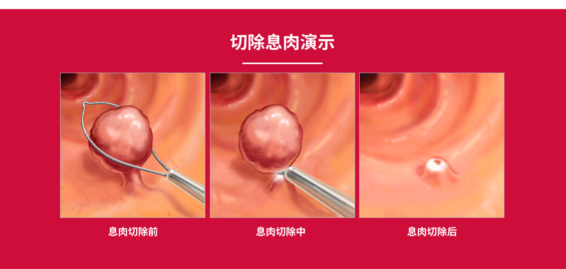 直肠指检和肠镜检查太尴尬？医生告诉你这两个检查的必要性