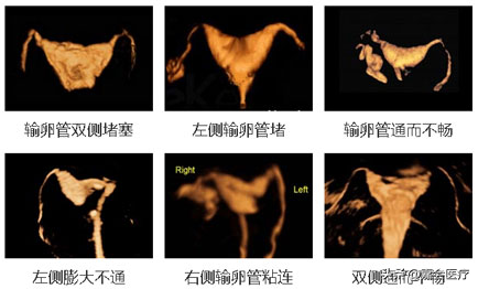 输卵管“堵”了怎么办？生殖科医生详解治疗方法