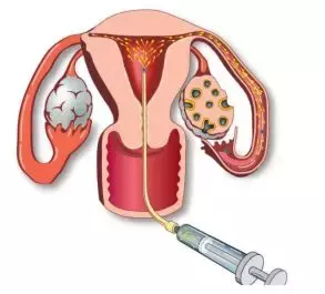 【看过来】人工授精，你了解吗？