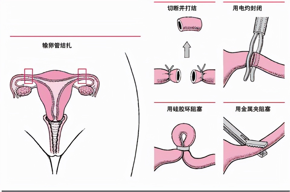 为什么结扎的基本都是男性？其实女性也可以，只是会面临5个弊端